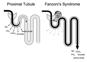 schema du syndrome de fanconi